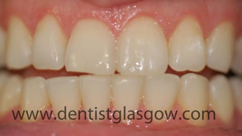 clear braces study after 3