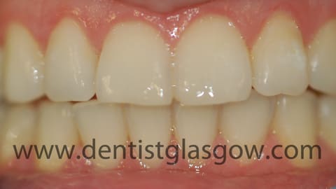 clear braces study after 4