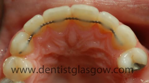 clear braces to straighten crooked teeth clear braces to straighten crooked teeth