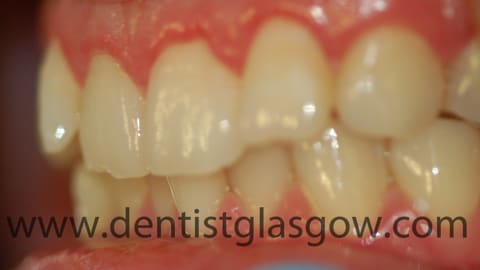 clear braces study before 1