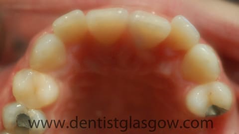 clear braces study before 2