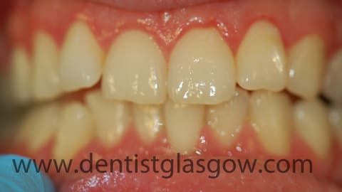 clear braces study before 3