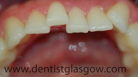 visibly crooked teeth visibly crooked teeth