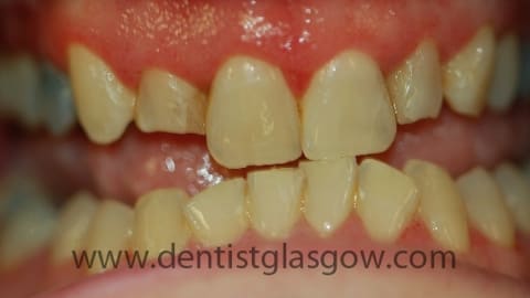 Before cosmetic dental work - image