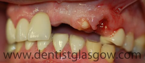 dental trauma requiring implant bridge 2