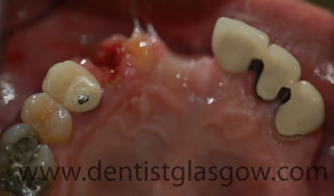 dental trauma requiring implant bridge 1