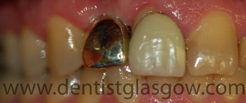 gold implant crown in place