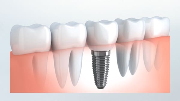 dental implant screw illustration