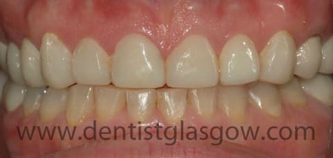 No more discoloured and overcrowded teeth after her braces and veneers treatment