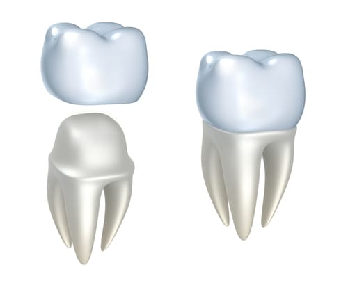 porcelain crowns in place
