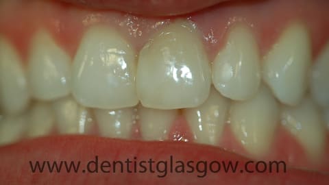 porcelain ceramic crowns - before photo