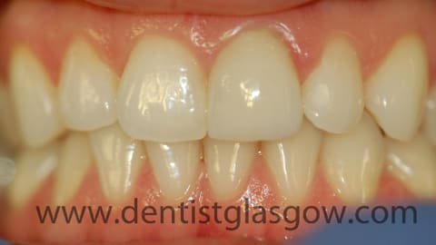 porcelain ceramic crowns after treatment 