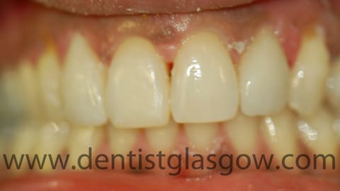 porcelain veneer on brown tooth after photo