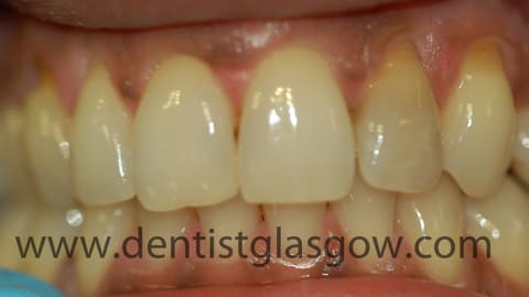 porcelain veneer on brown tooth before photo
