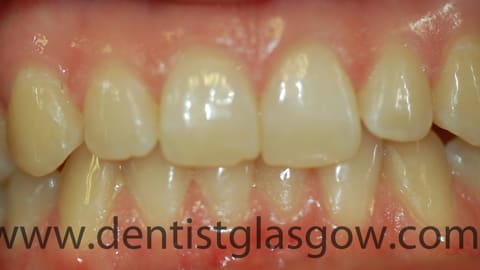 six month smiles teeth from front before treatment