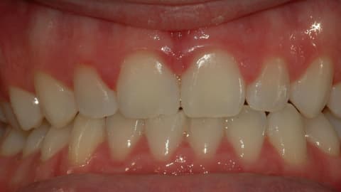 After Cosmetic Braces