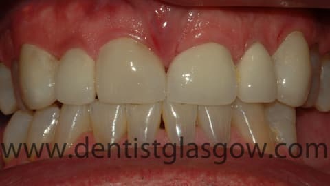 After Porcelain Crowns