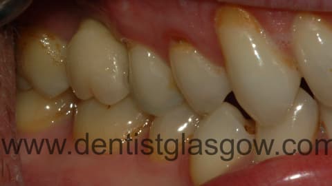 Afterimplant