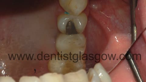 Afterimplant2