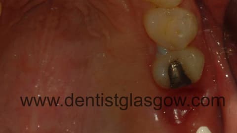Extracted tooth 2