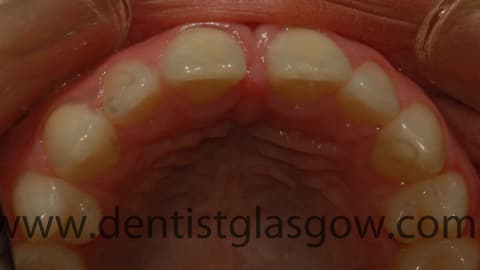 Gap In Teeth2