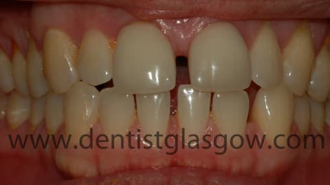 Porcelain veneers before
