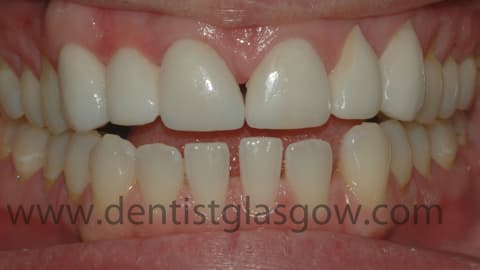 Porcelain veneers closing the gap between her front teeth