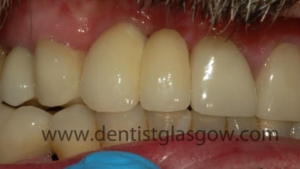 After dental implant