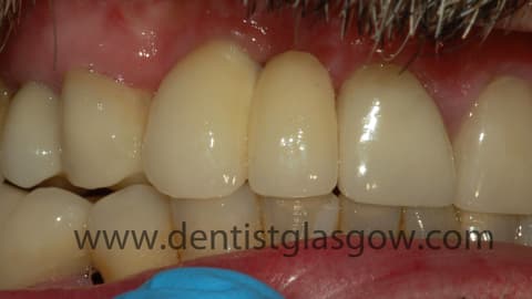 After dental implant