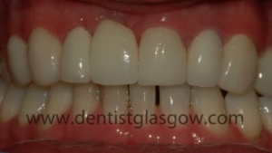 Jared's teeth after dental implants