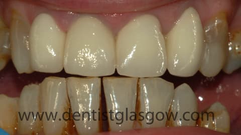 Moira received a porcelain veneer and two porcelain crowns 