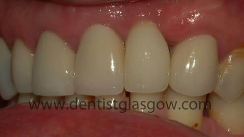 Replaced_dental_crown