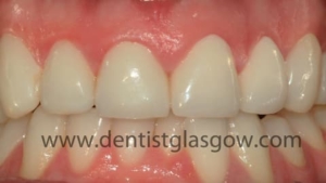 Same day veneers