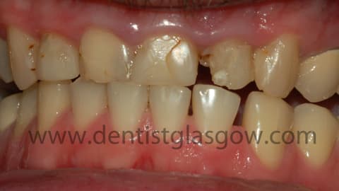 Brokenteeth
