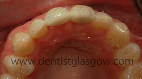 Cantileverdentalbridge