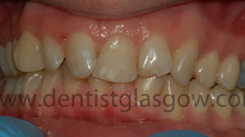 Customsixmonthsmiles