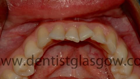 Customsixmonthsmiles3