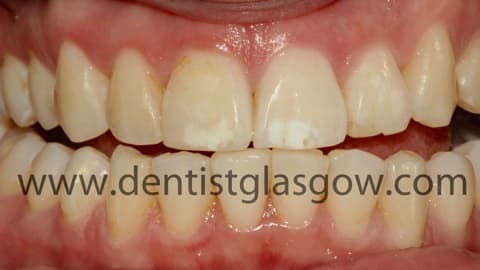 Customsixmonthsmiles6