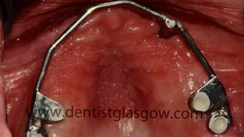 Titanium Bar on Implants