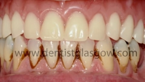Titanium Bar With Dental Implants