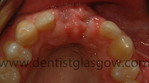 Toothlossfromassault