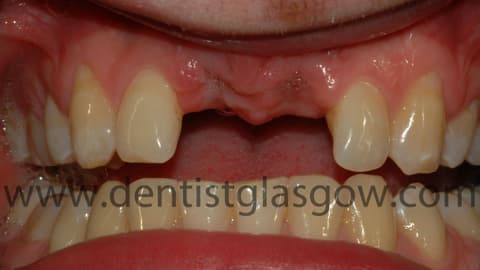 Traumatic tooth loss