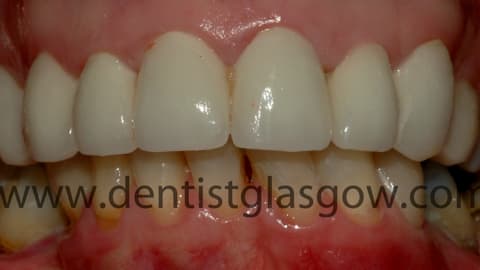 New Porcelain Crowns