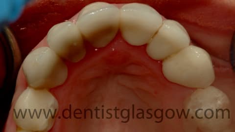 New Porcelain Crowns2