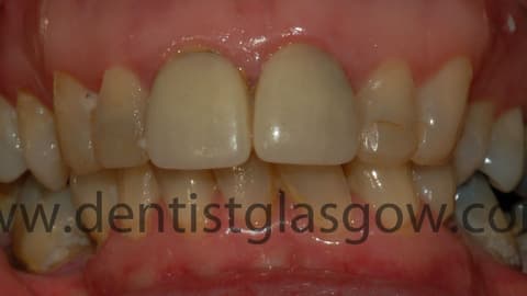 Old Porcelain Veneers