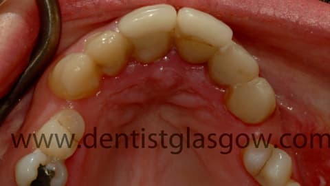 Old Porcelain Veneers2