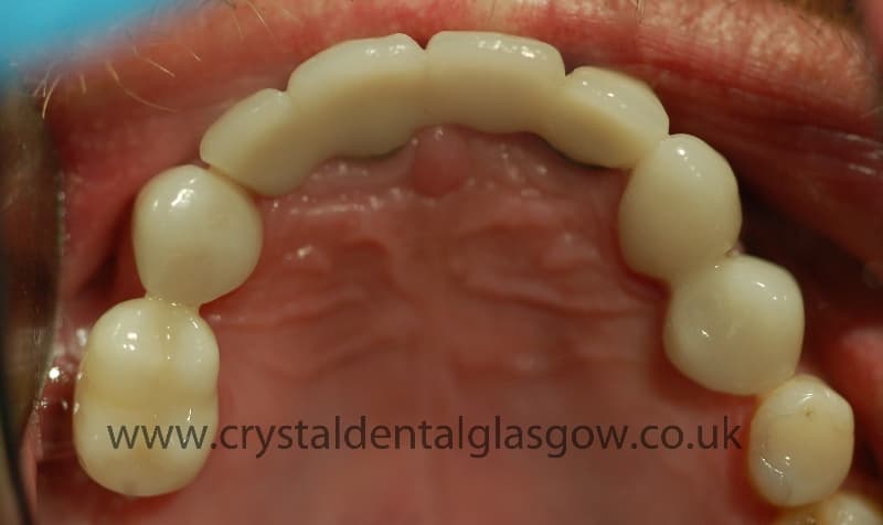 After Dental Bridge 2