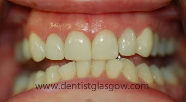 After Teeth Whitening