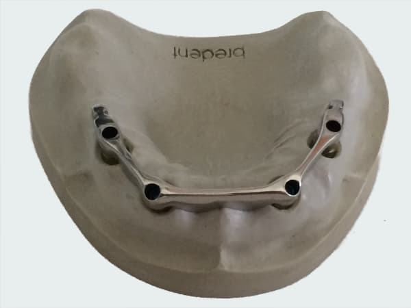 All On 4 Implant Screws
