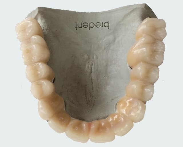 All On 4 Implant Teeth